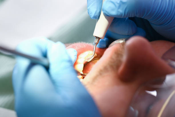 Best Emergency Root Canal Treatment in Mooresville, NC